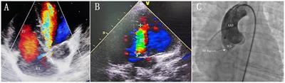 Case Report: Transcatheter Closure of Ruptured Sinus of Valsalva With Ventricular Septal Defect Occluder in a 3-Year-Old Child After Repair of Ventricular Septal Defect